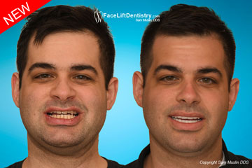 Underbite Failed Jaw Surgery - Before and After Photo