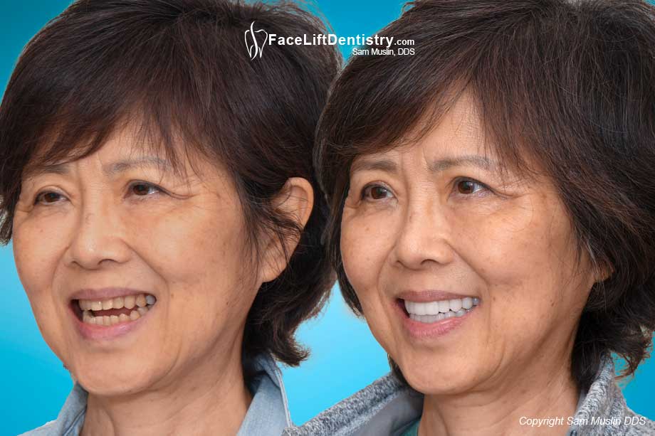 TMD Pain and Anterior Open Bite Fixed, No Surgery - Before and After Photo