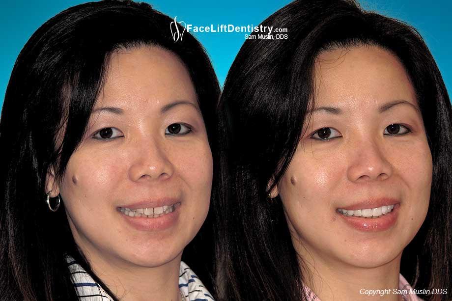 Tetracycline Stains and Porcelain Veneers - Before and After Photo