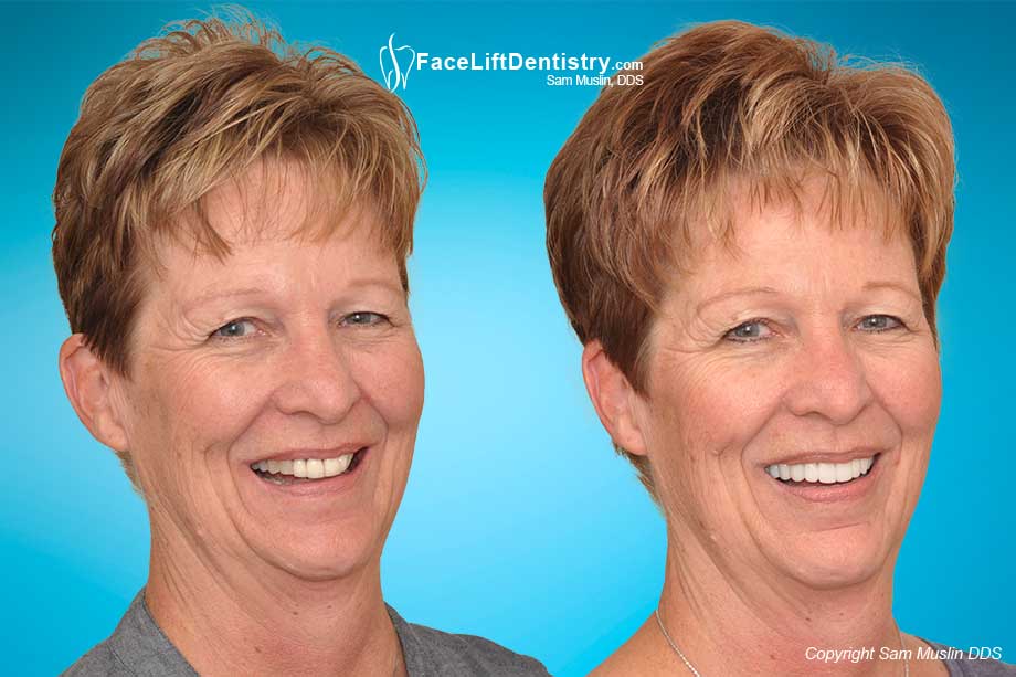 Neuromuscular Dentistry vs. JawTrac Jaw Positioning - Before and After Photo