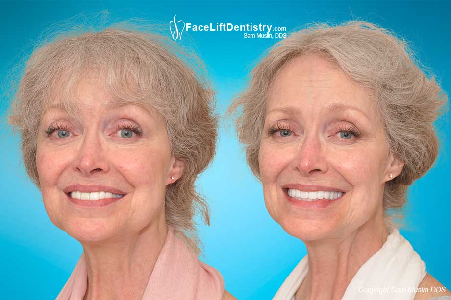 Tooth Shaving and Veneers can Destroy your Bite - Before and After Photo