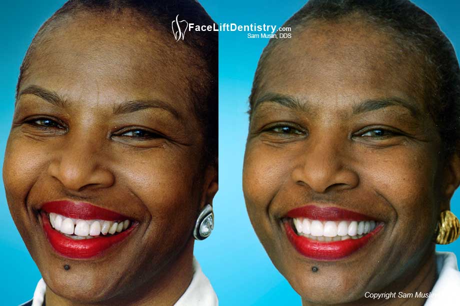 Gaps Between Crowns and Bad Cosmetic Dentistry - Before and After Photo