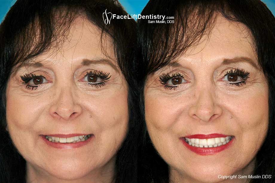 Older Looking Faces from Braces and Teeth Extractions - Before and After Photo