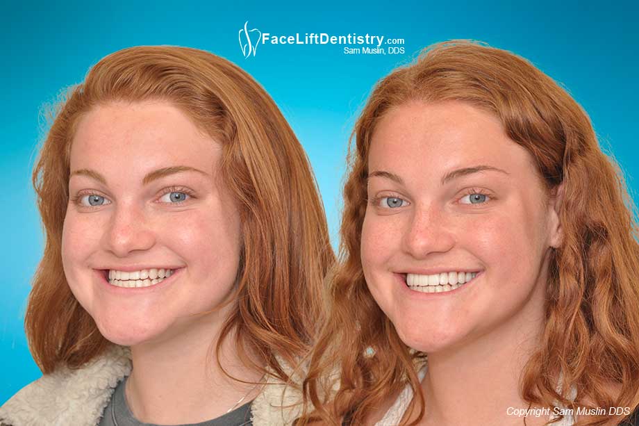 Underbite Protruding Chin - Before and After Photo