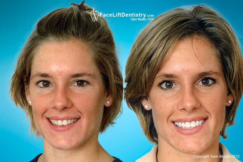 Broken Teeth, Bad Porcelain Crowns - Before and After Photo