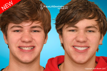 Class 2 Overbite - Before and After Photo