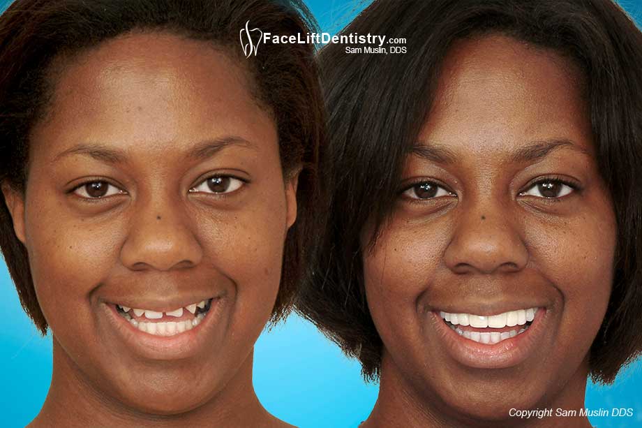 Before and After Photos | Bite Correction without Surgery or Braces