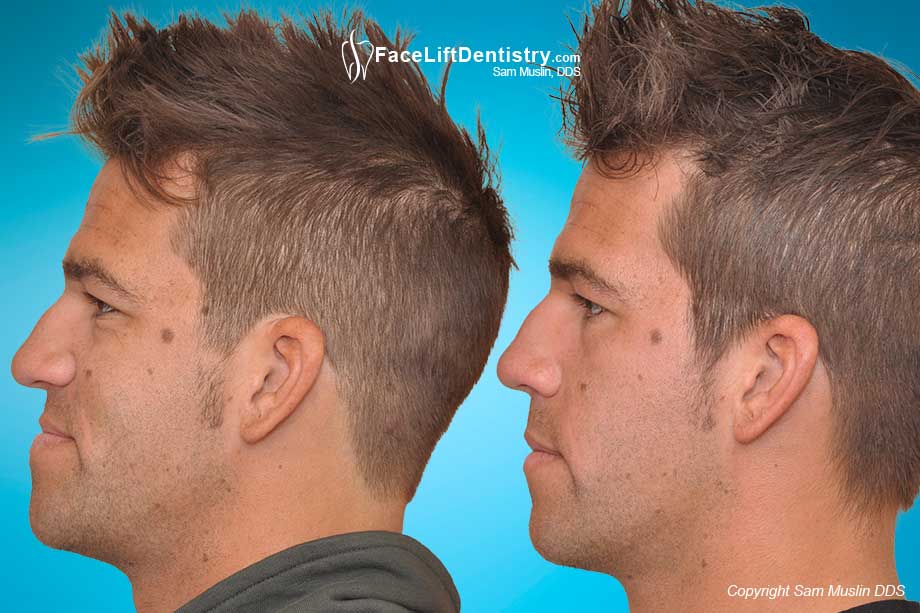 jaw surgery without underbite correction before braces moving bite lower under overbite face teeth jawline dentistry results non treatment fix