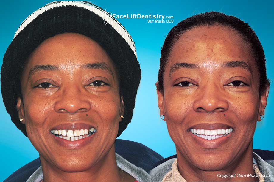 Negative Effects of Teeth Removal for Braces - Before and After Photo