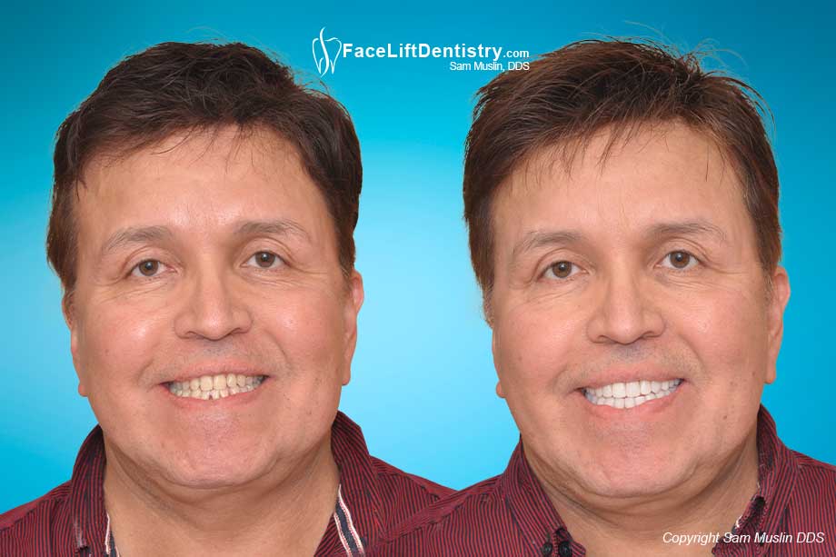 Failed Jaw Surgery Non-Surgical Correction - Before and After Photo