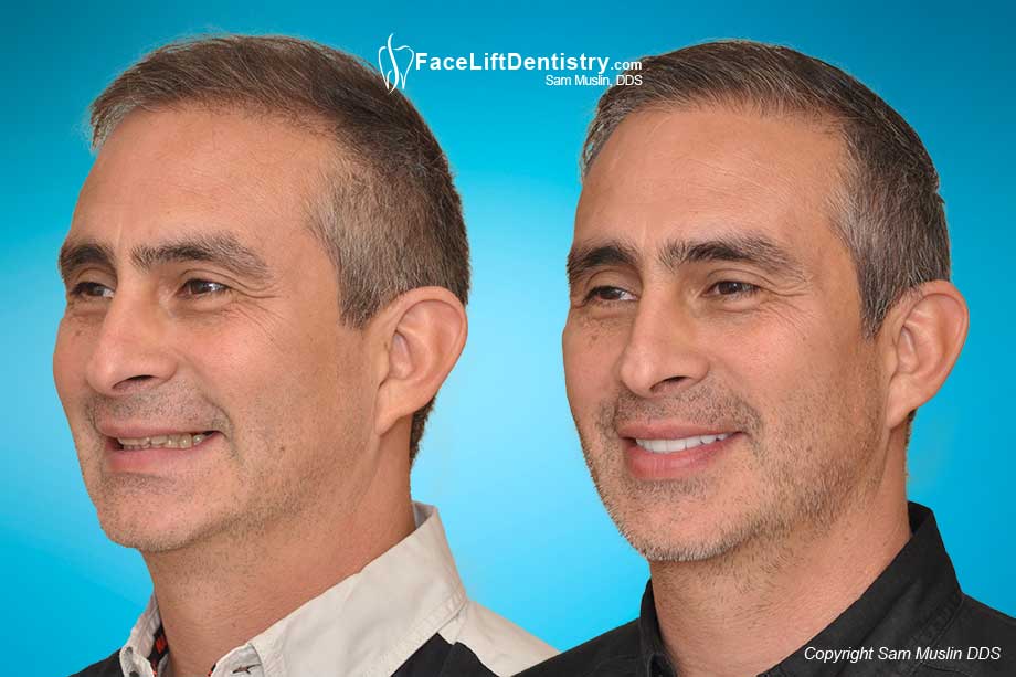 underbite overbite chin bite tmj