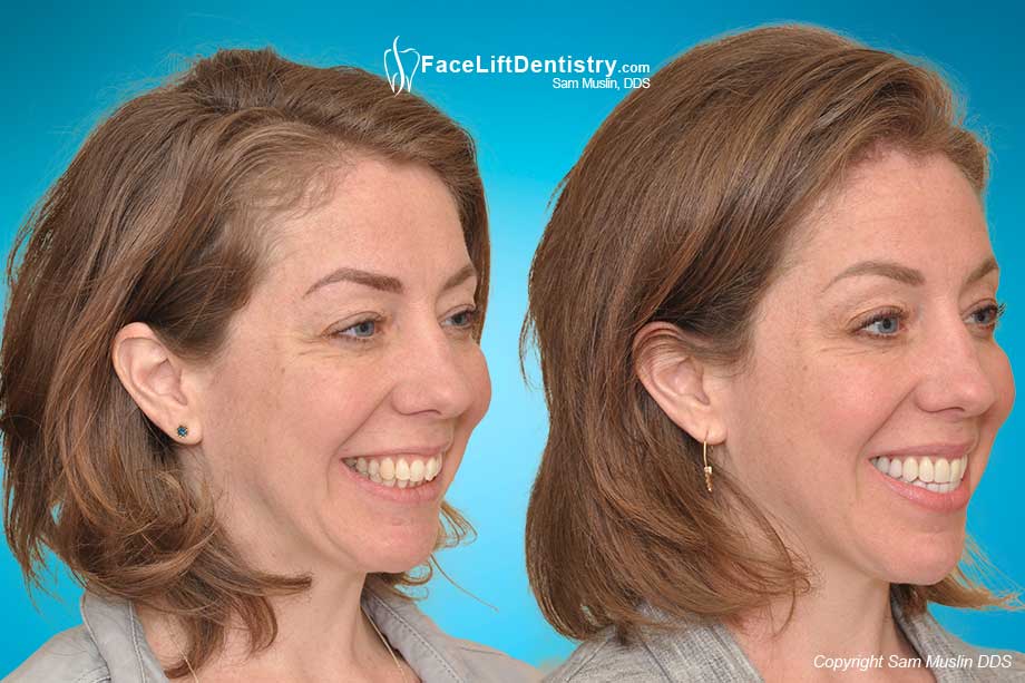 Overbite Jaw Position and Tension - Before and After Photo