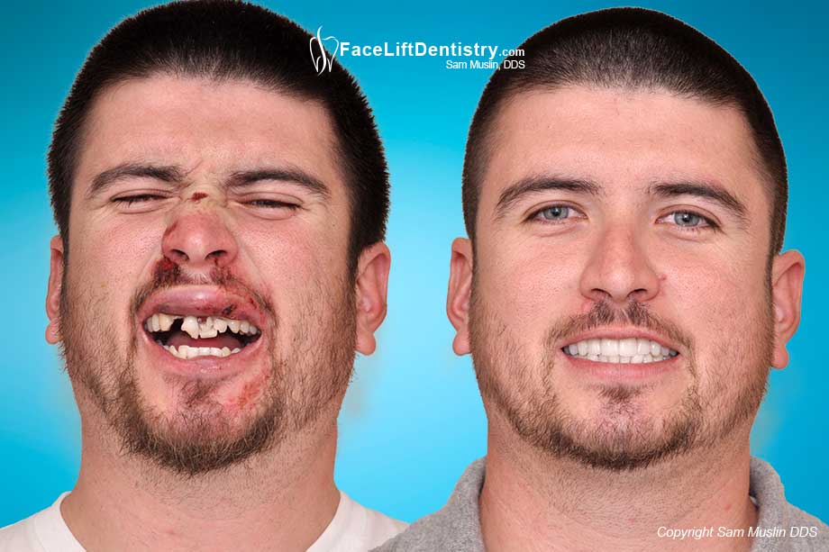 Skateboard Accident- Broken and Knocked Out Teeth - Before and After Photo