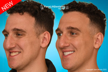 Underbite Crossbite Fix - Before and After Photo