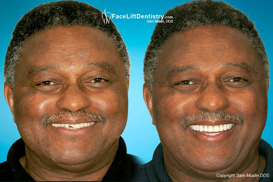 Dad, Please Get Your Teeth Fixed - Before and After Photo