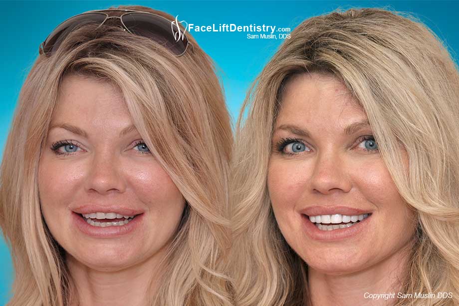 Overbite and Short Worn Teeth - Before and After Photo