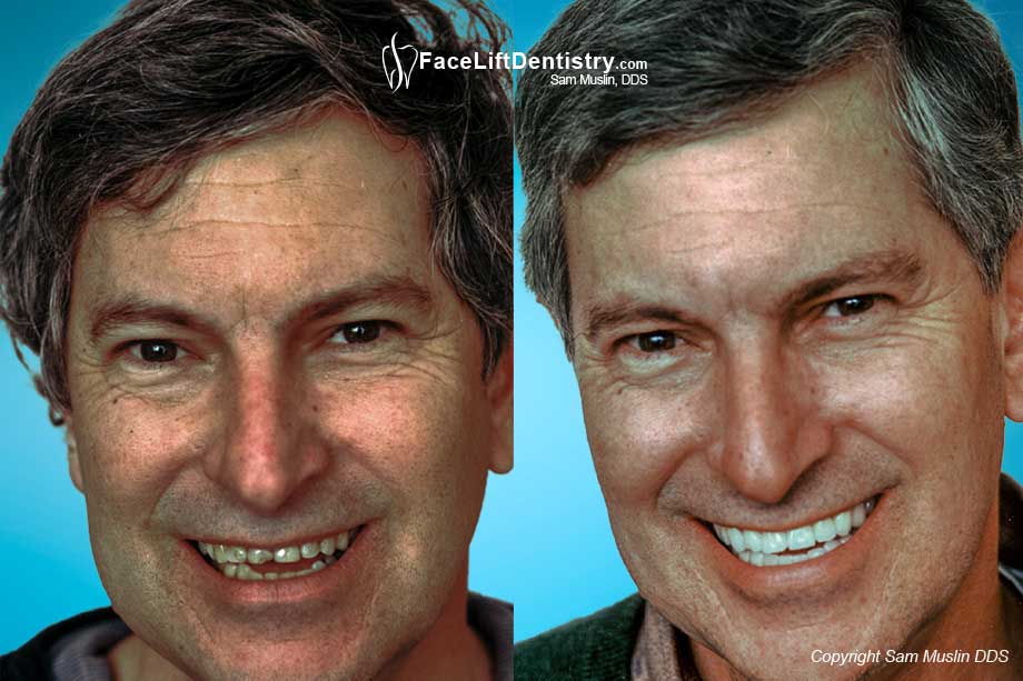 Bad Bite, Bad Crowns and Bad Root Canals - Before and After Photo