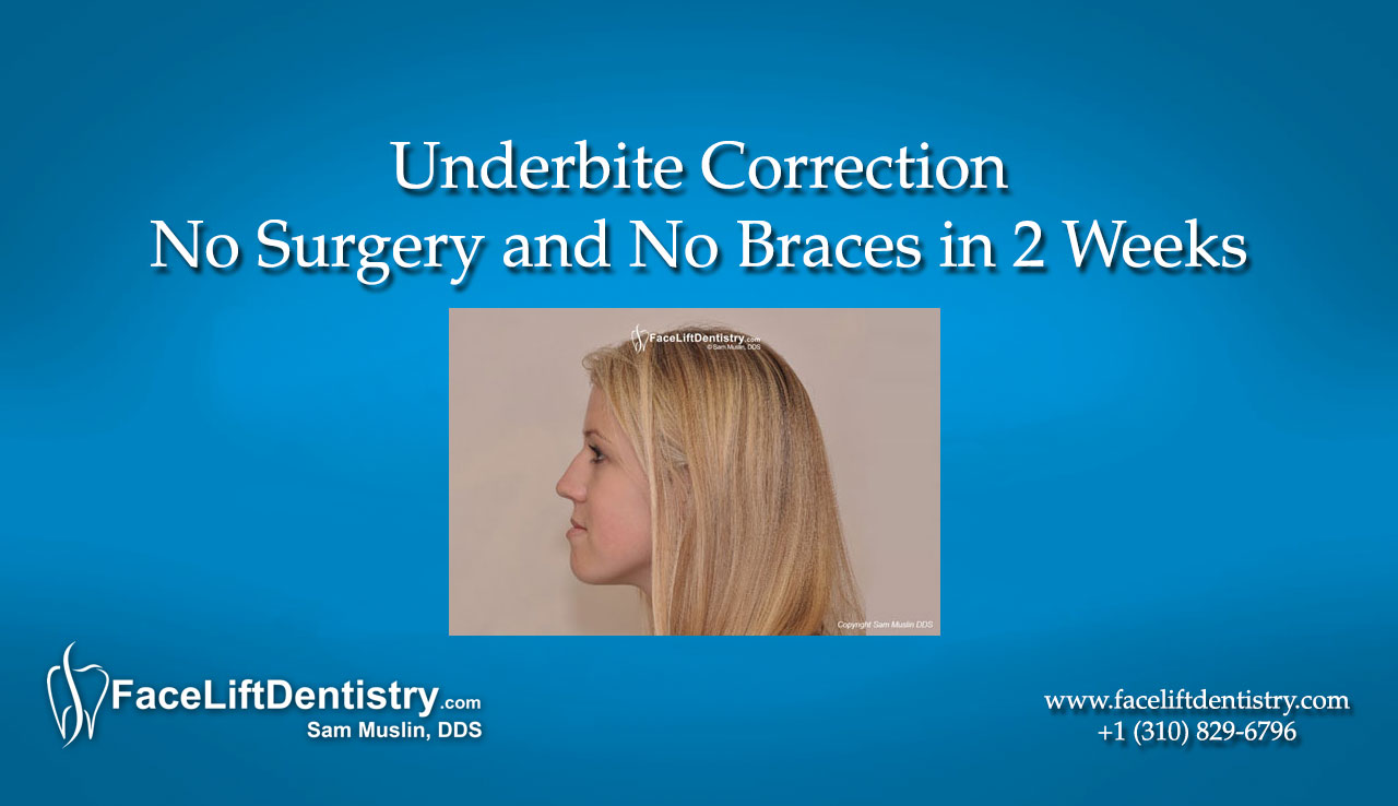underbite correction with venlay restorations underbite surgery