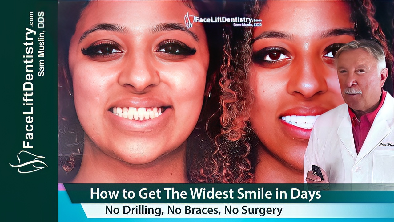 Bite Correction for the Widest Smiles, Explained