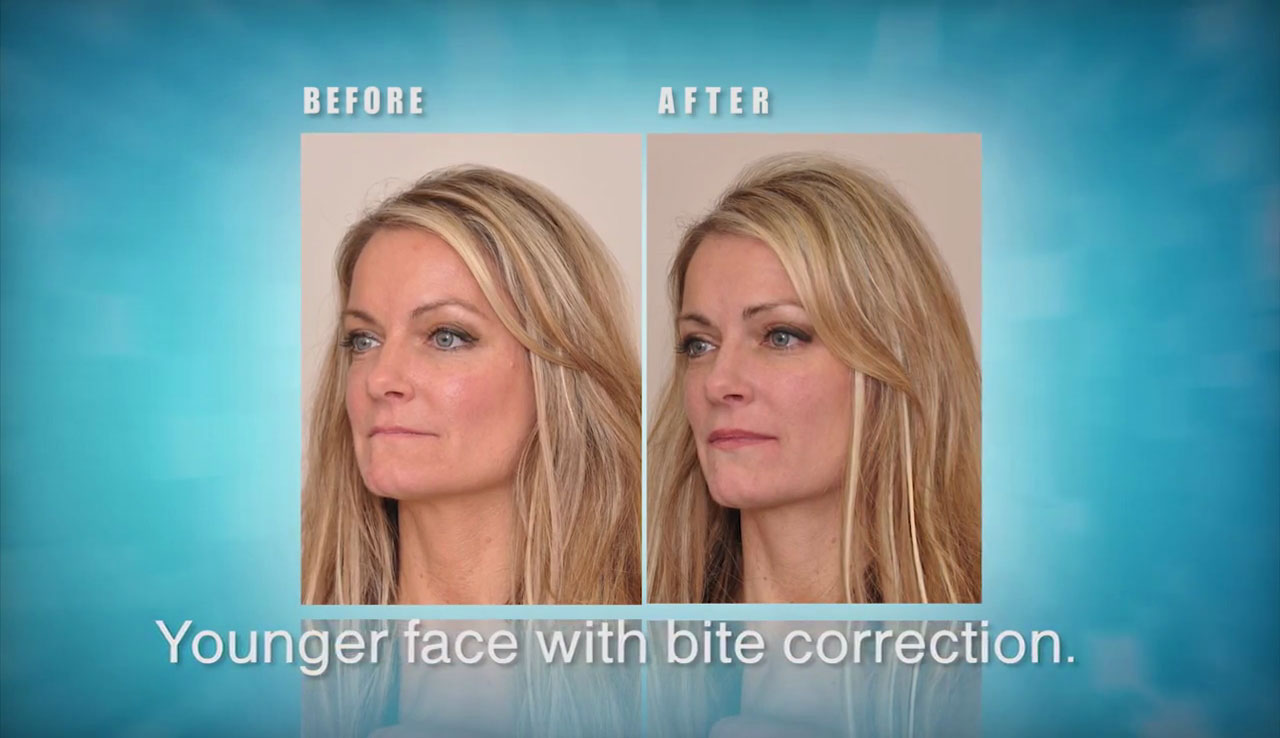 NoSurgery Bite Correction, Mouth Reconstruction, Face Lifts